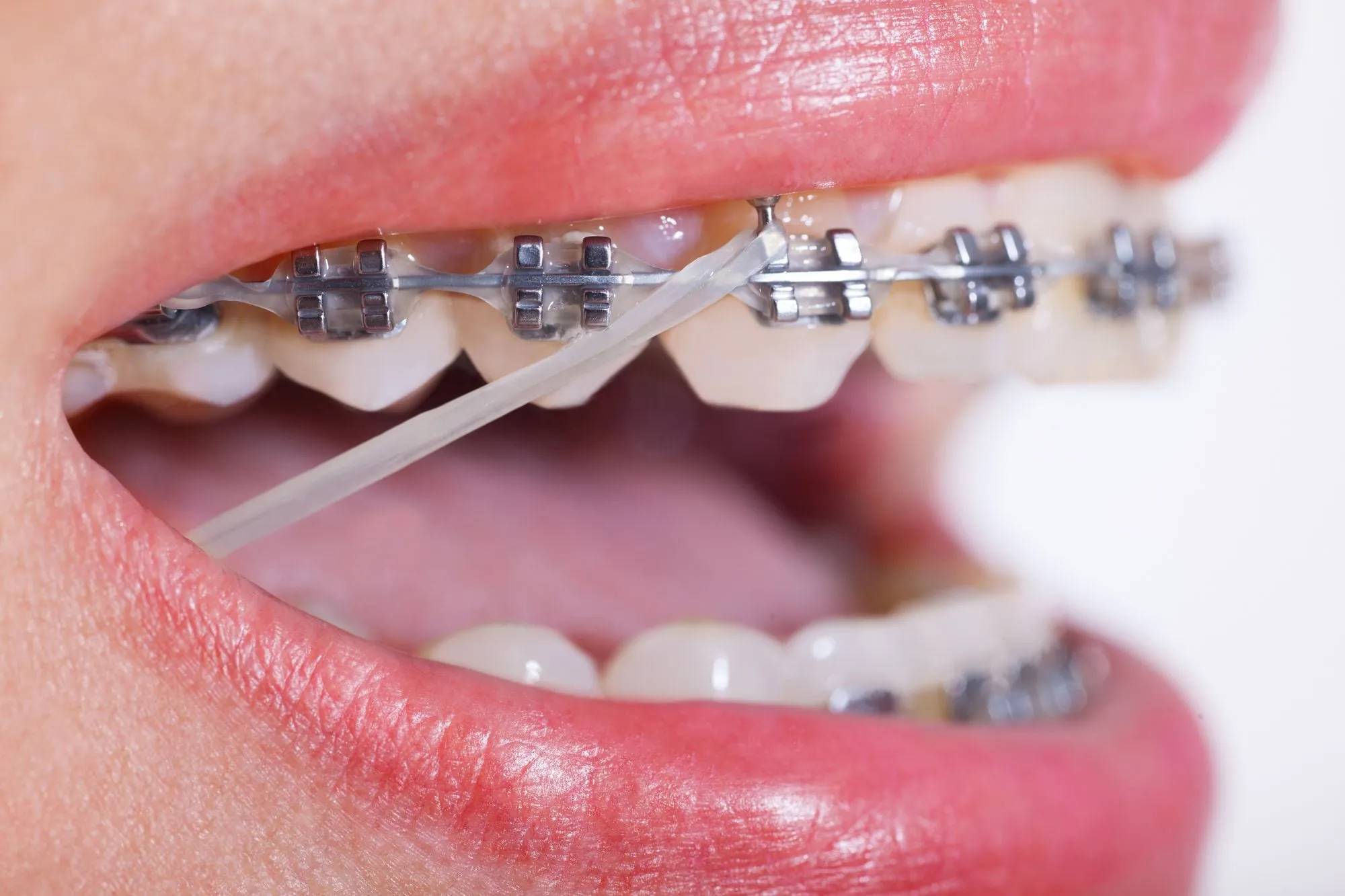 Close-up of braces with an orthodontic elastic connecting the upper and lower teeth