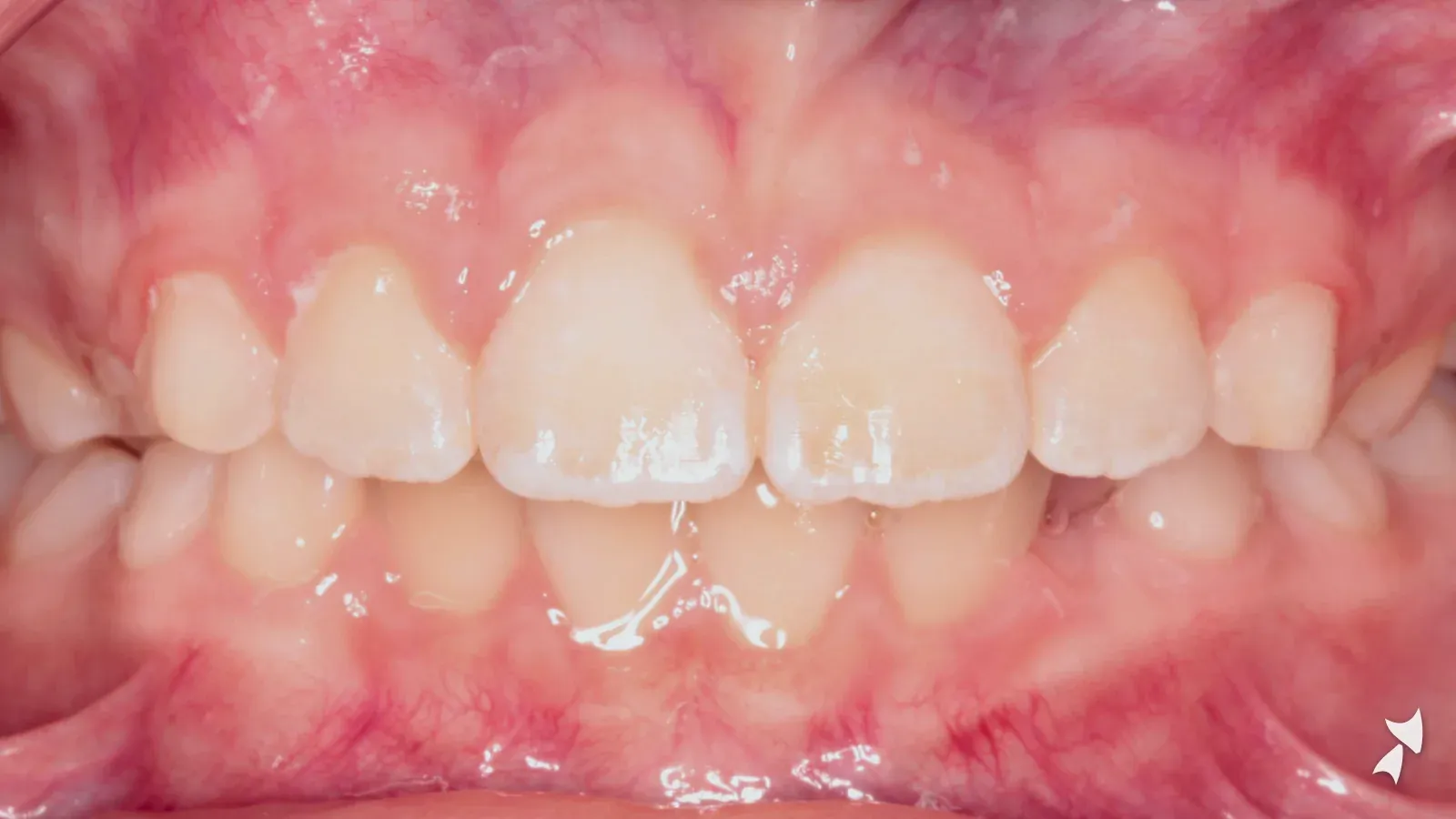 Front view of a patient's teeth after orthodontic treatment: thumb-sucking habit