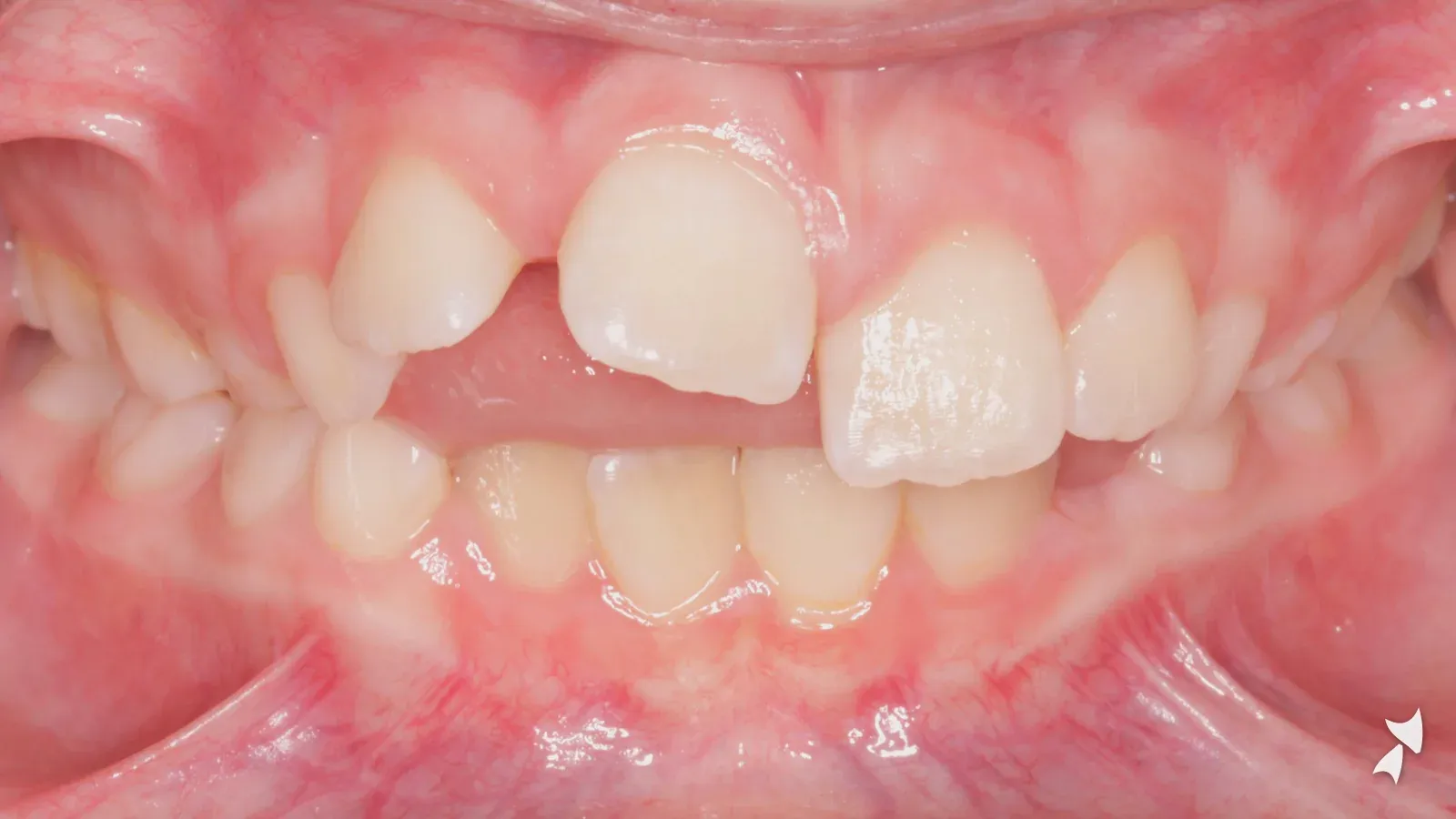 Front view of a patient's teeth before orthodontic treatment: thumb-sucking habit