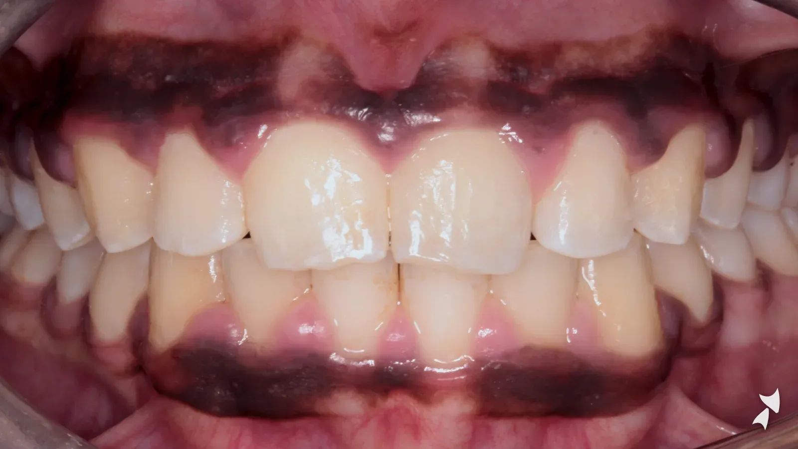 Front view of a patient's teeth after orthodontic treatment: overbite