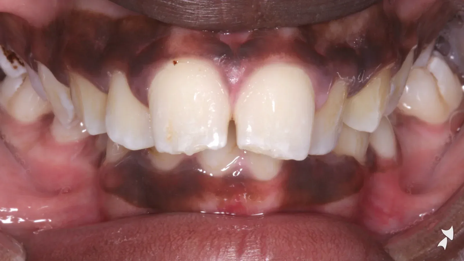 Front view of a patient's teeth before orthodontic treatment: overbite