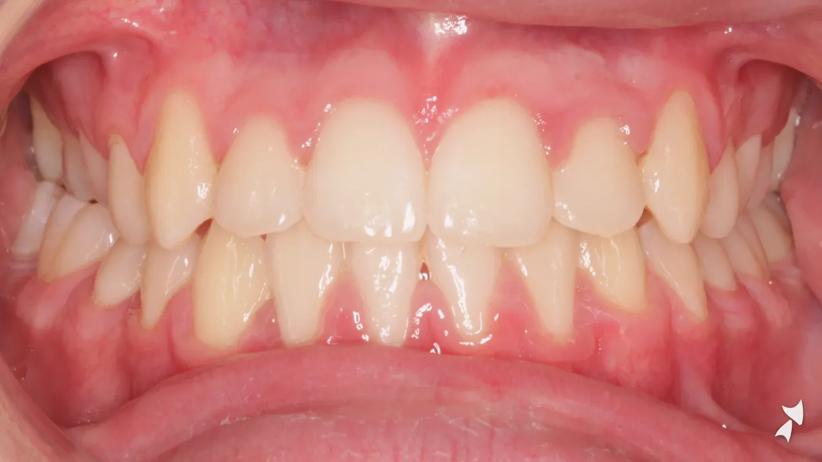 Front view of a patient's teeth after orthodontic treatment: underbite