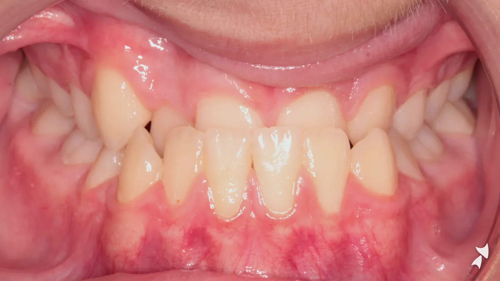 Front view of a patient's teeth before orthodontic treatment: underbite