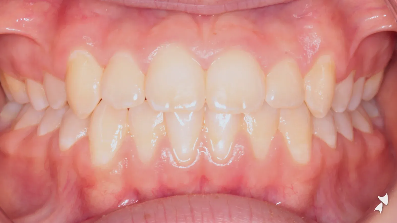 Front view of a patient's teeth after orthodontic treatment: anterior crossbite