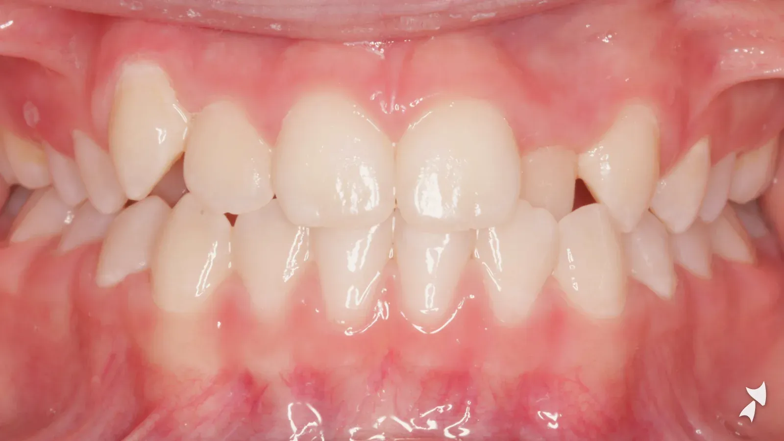 Front view of a patient's teeth before orthodontic treatment: anterior crossbite