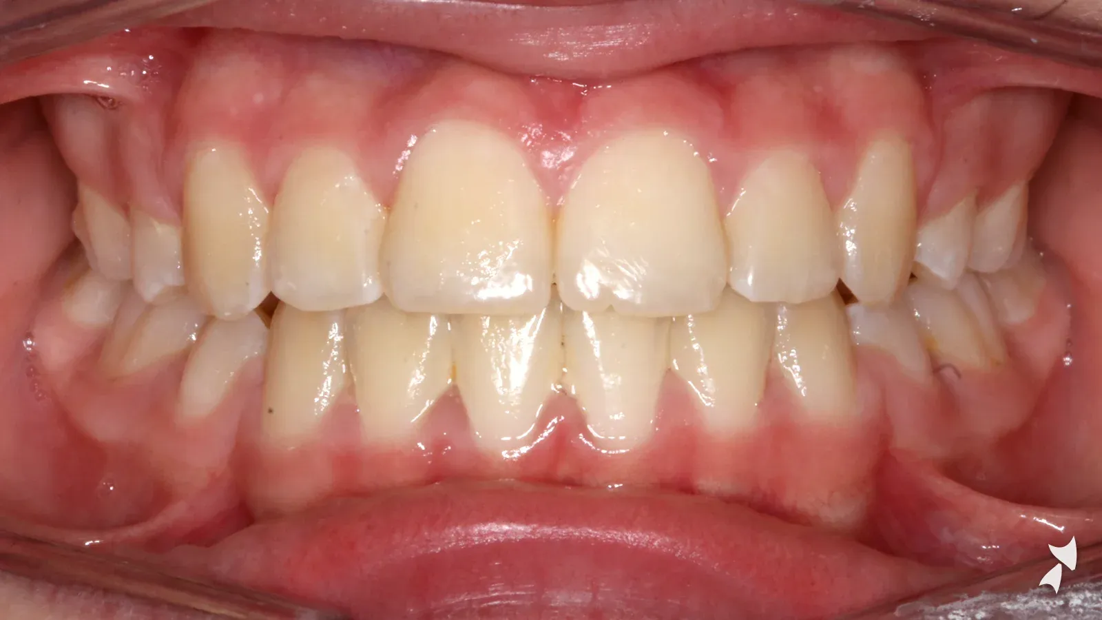Front view of a patient's teeth after orthodontic treatment: high canines