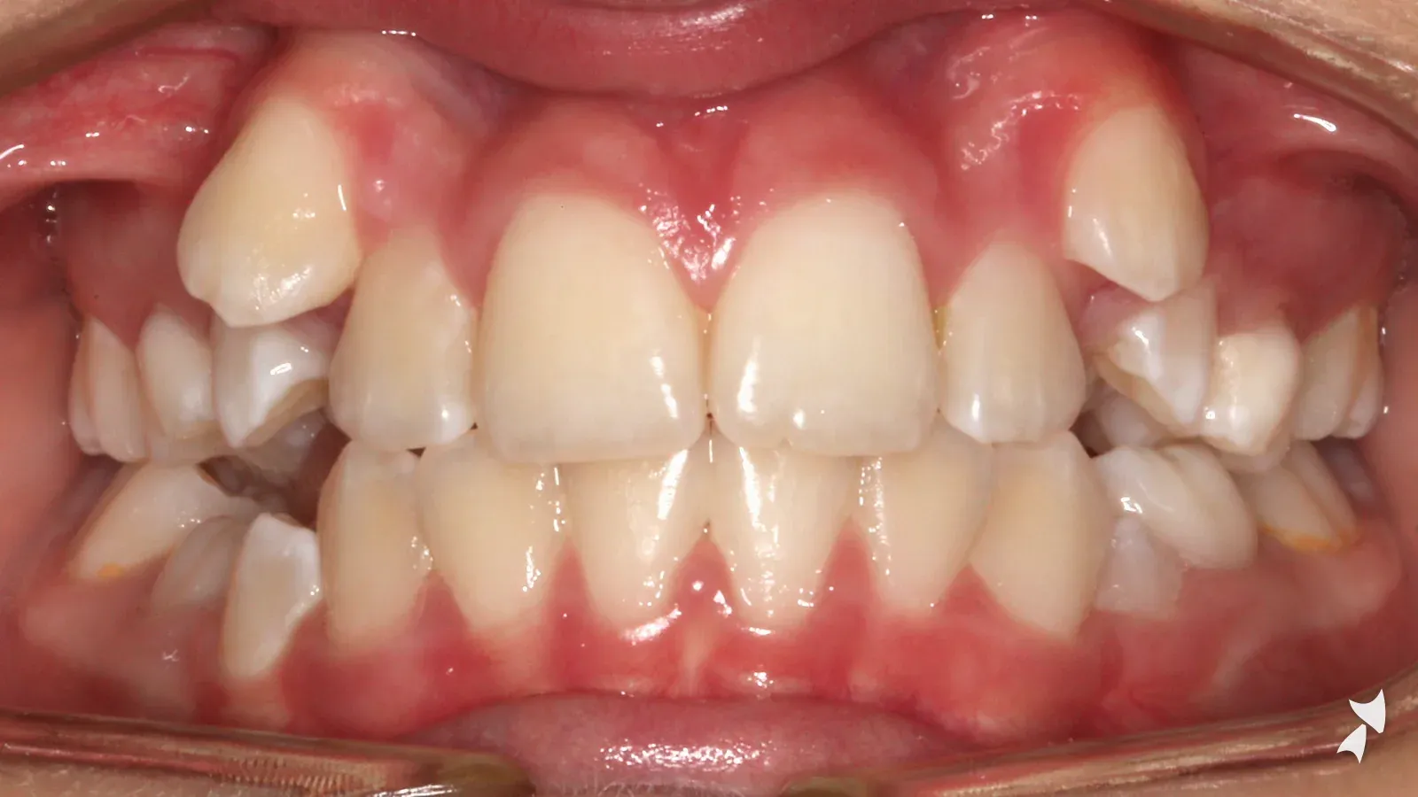 Front view of a patient's teeth before orthodontic treatment: high canines