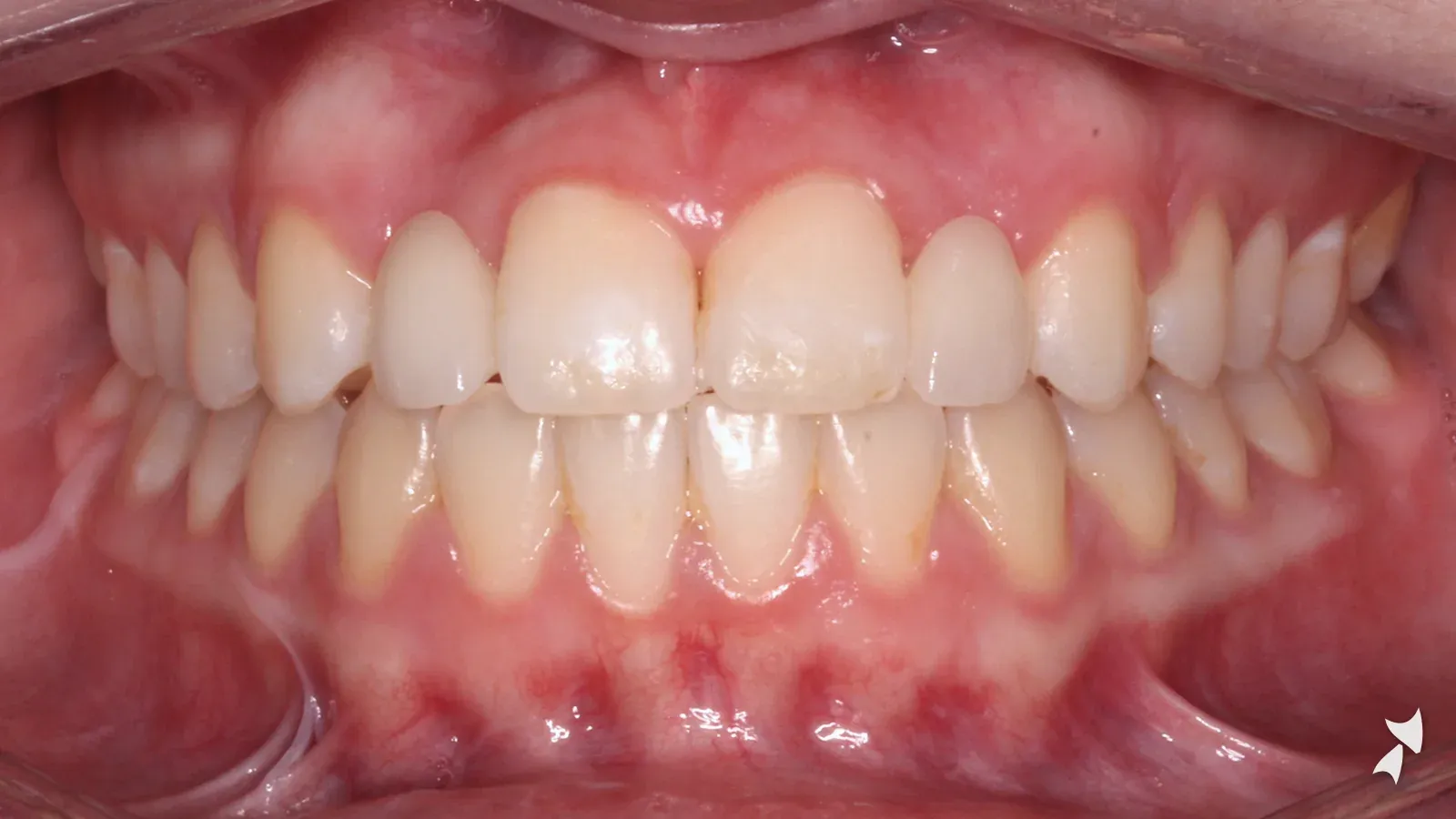 Front view of a patient's teeth after orthodontic treatment: missing upper lateral incisors