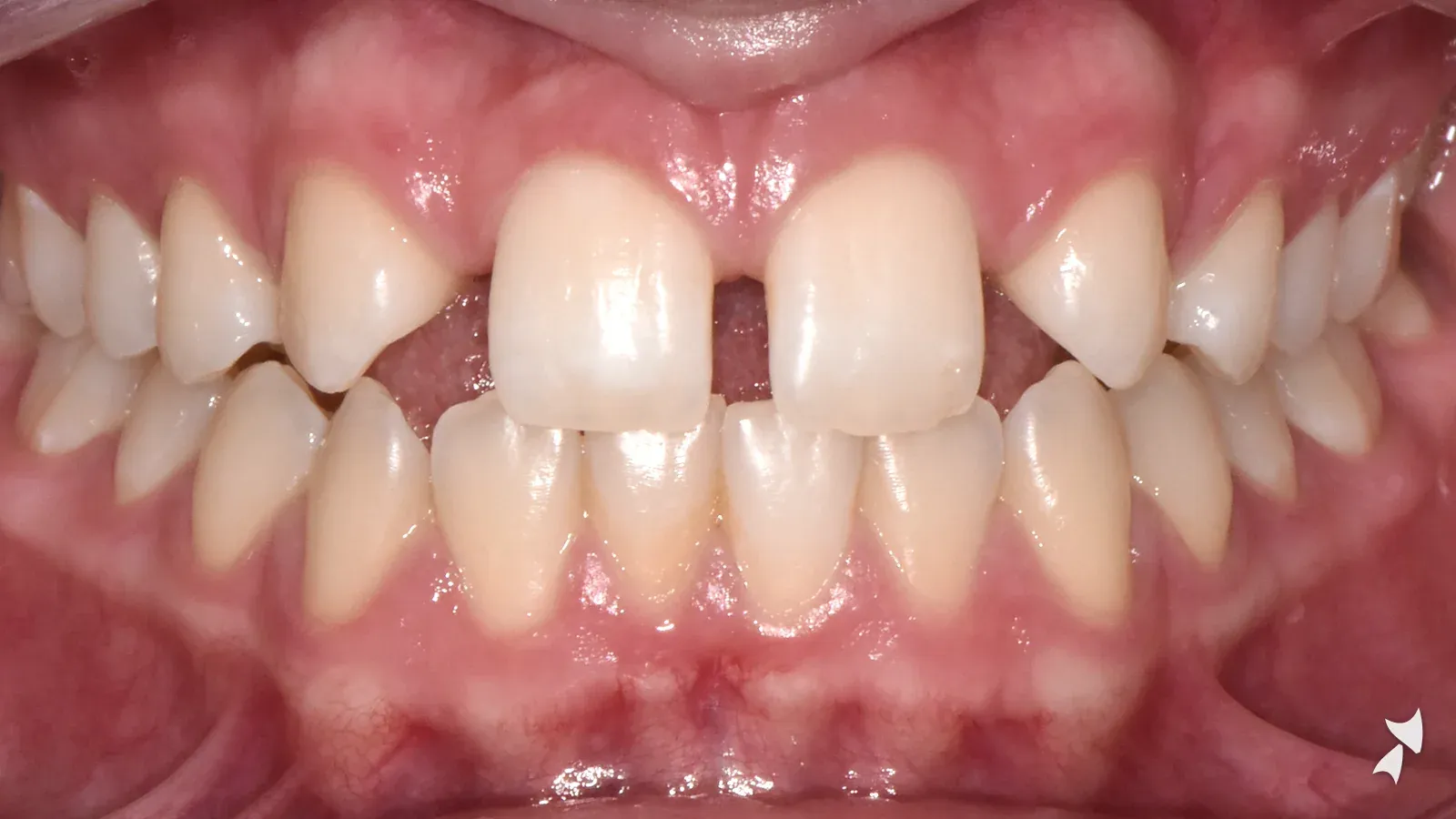 Front view of a patient's teeth before orthodontic treatment: missing upper lateral incisors