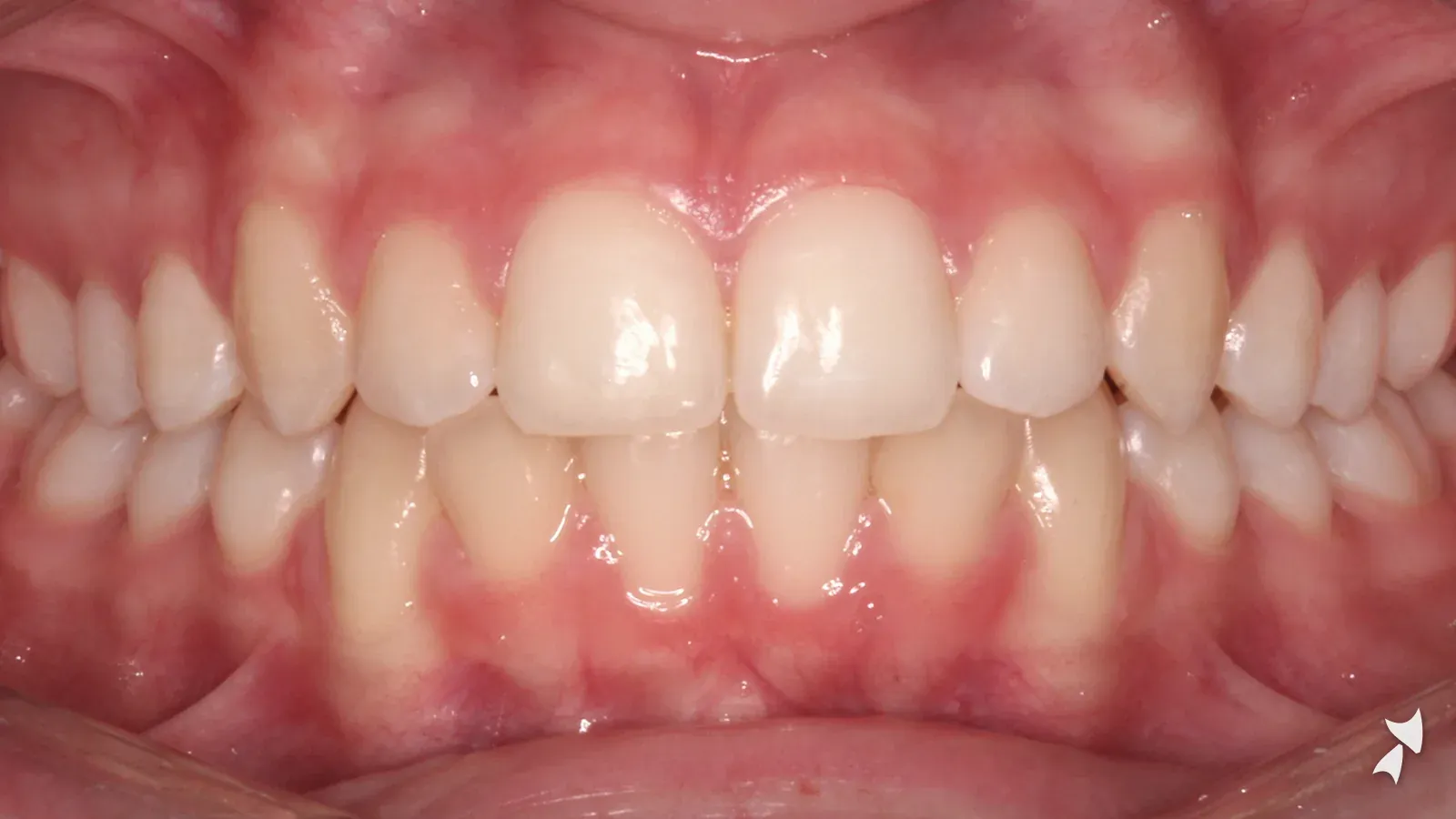 Front view of a patient's teeth after orthodontic treatment: deep bite