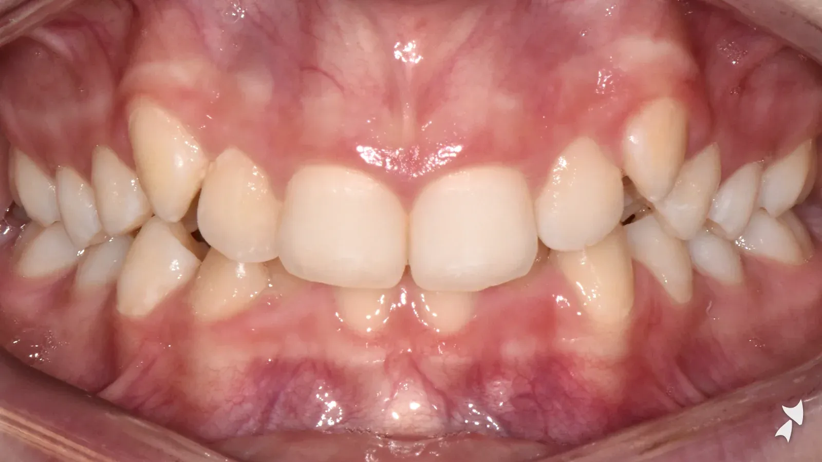 Front view of a patient's teeth before orthodontic treatment: deep bite