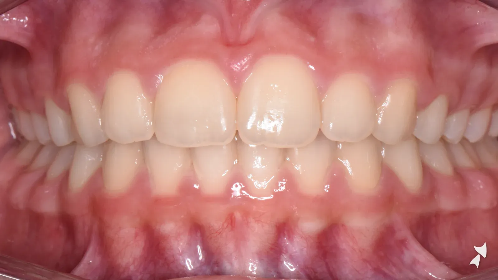 Front view of a patient's teeth after orthodontic treatment: crowded upper lateral incisor