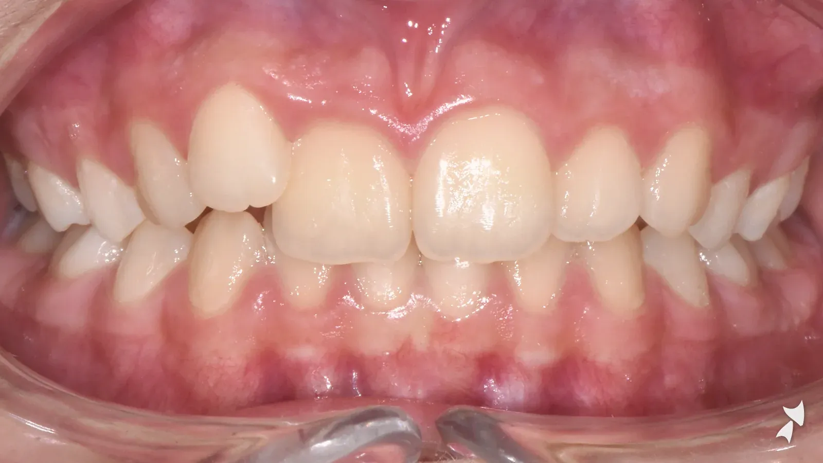 Front view of a patient's teeth before orthodontic treatment: crowded upper lateral incisor
