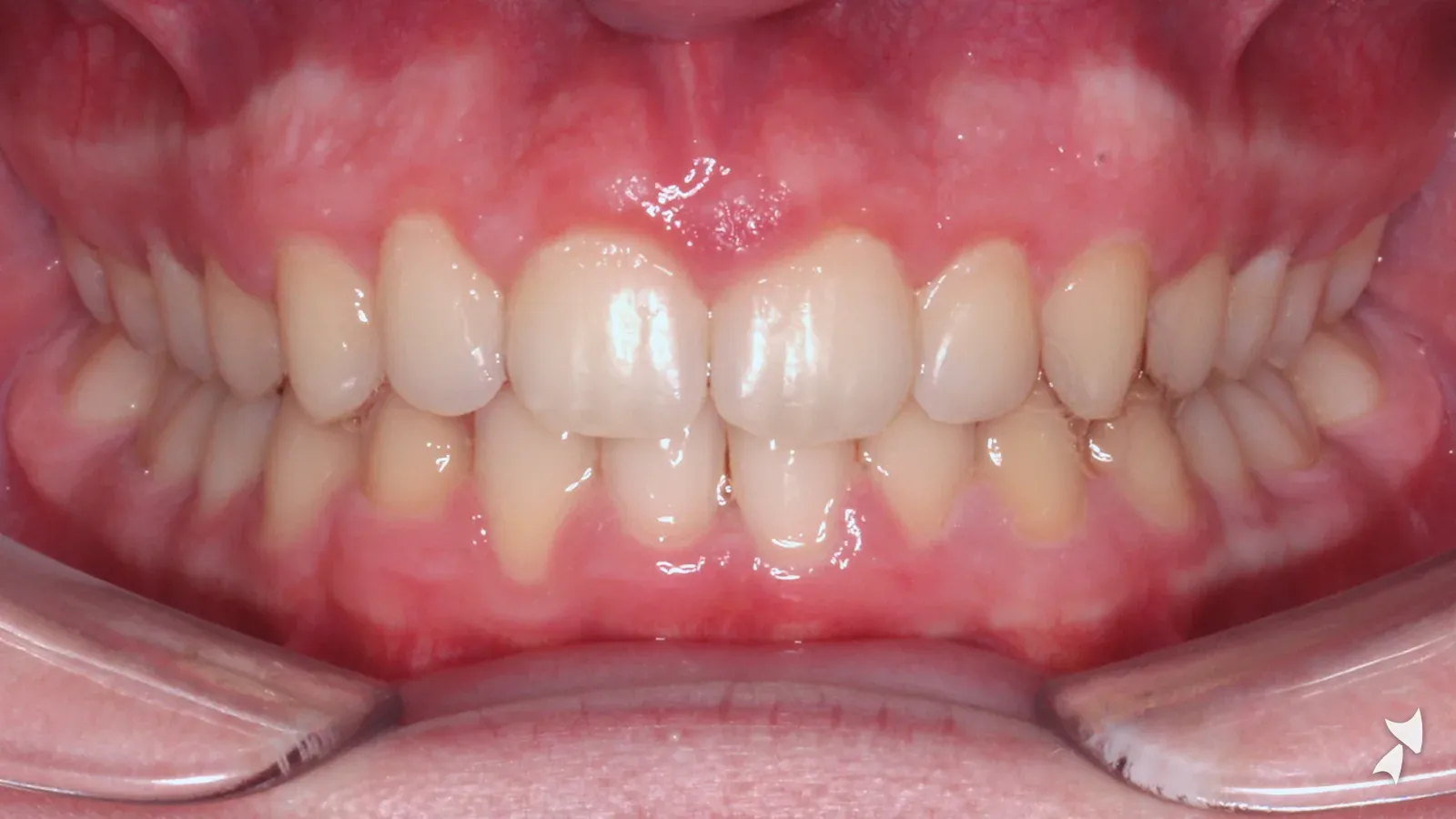 Front view of a patient's teeth after orthodontic treatment: deep bite with a tilted bite