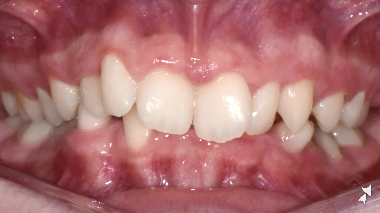 Front view of a patient's teeth before orthodontic treatment: deep bite with a tilted bite