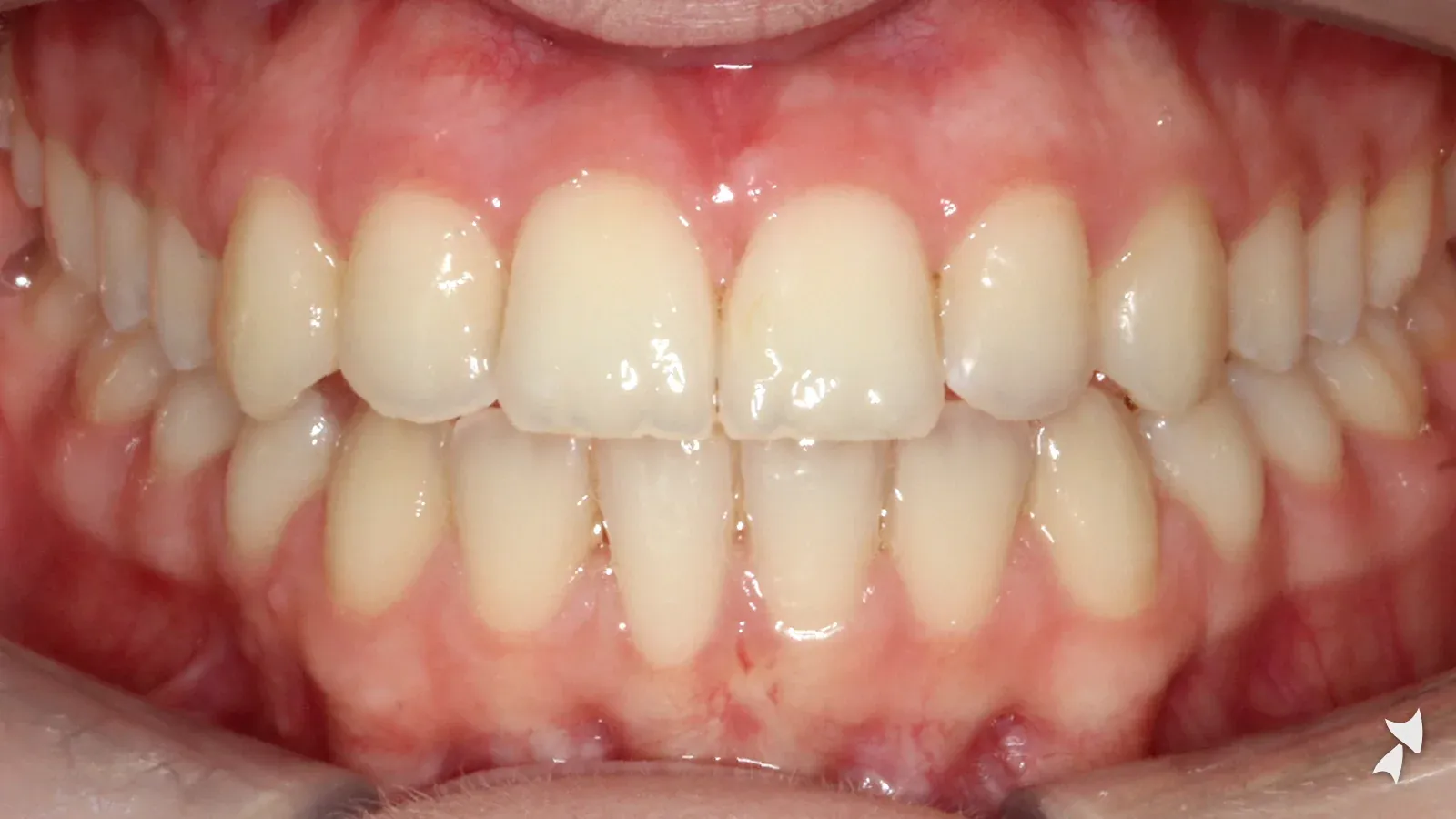 Front view of a patient's teeth after orthodontic treatment: narrow upper arch with crowding