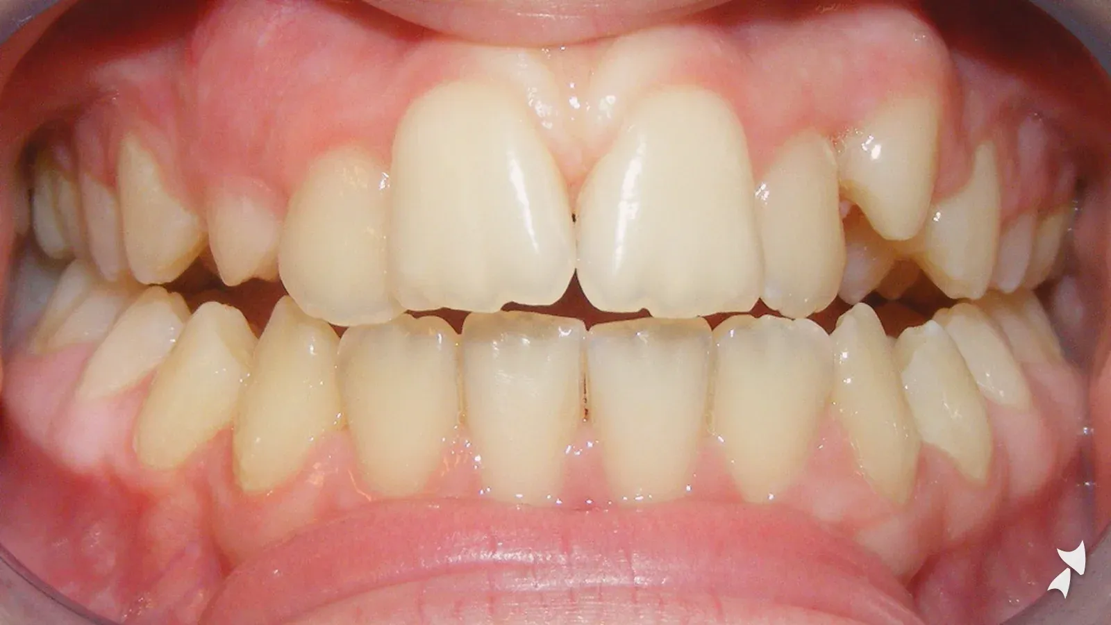 Front view of a patient's teeth before orthodontic treatment: narrow upper arch with crowding