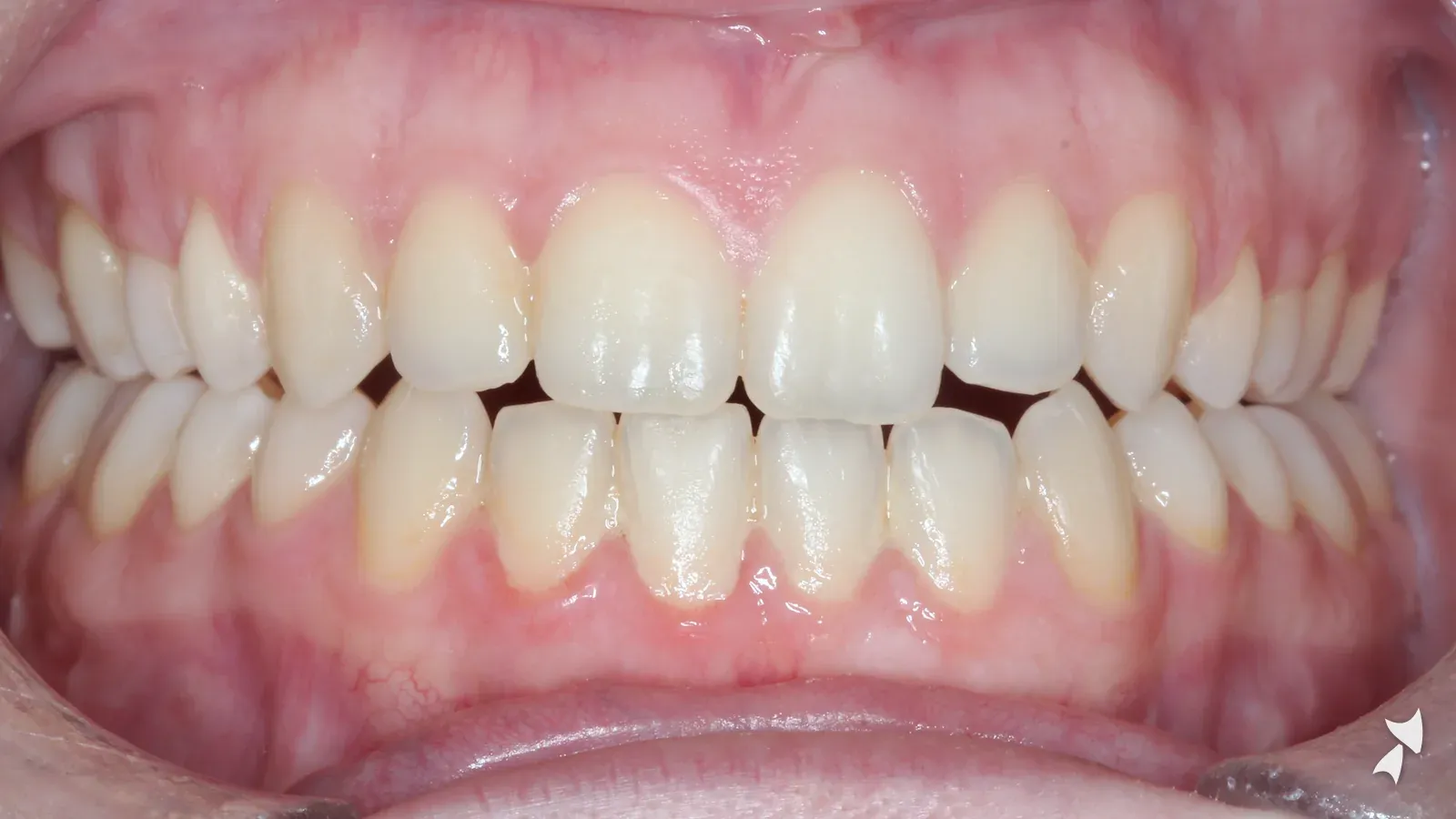 Front view of a patient's teeth after orthodontic treatment: anterior open bite treated with jaw surgery