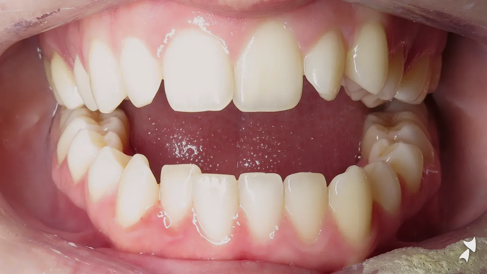 Front view of a patient's teeth before orthodontic treatment: anterior open bite treated with jaw surgery