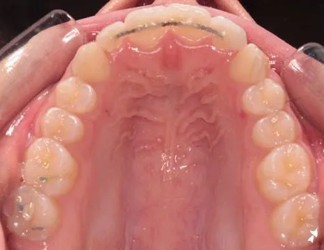 A fixed wire retainer bonded behind the upper front teeth, viewed from below, photographed in clinic