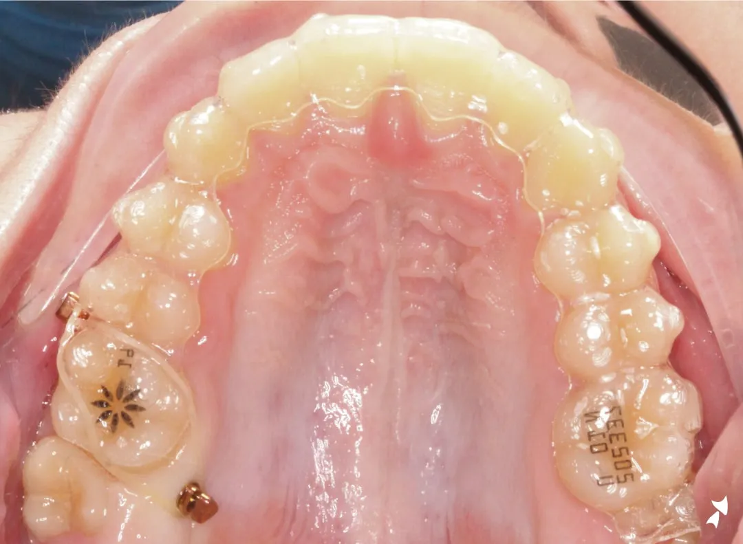 A clear aligner fitted to the upper teeth, viewed from below, photographed in clinic