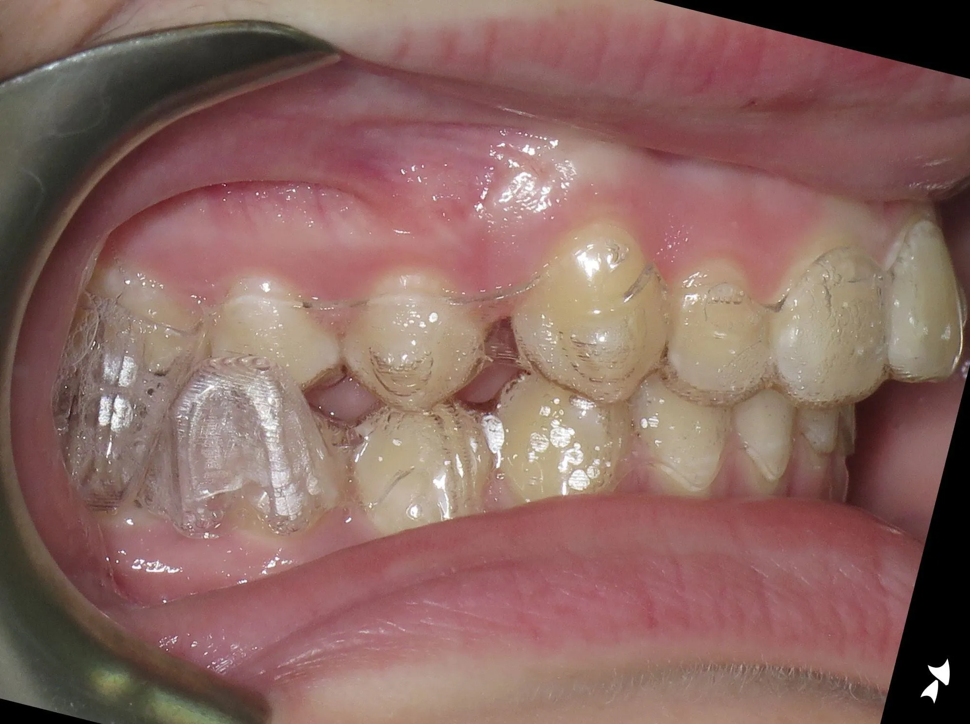 Clear aligners fitted to the teeth, side view, photographed in clinic