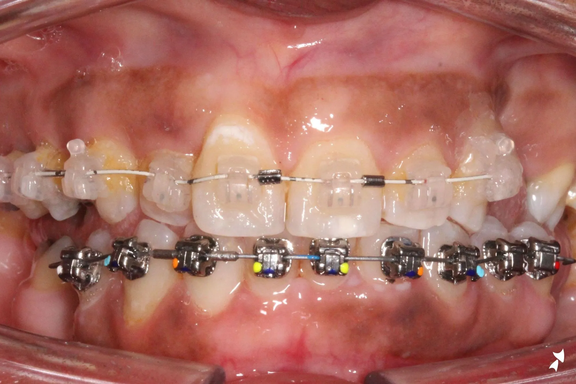 Tooth-coloured braces on the upper teeth and metal braces on the lower teeth, photographed in clinic