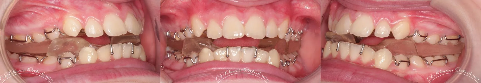 A twin block functional appliance shown from three angles, photographed in clinic