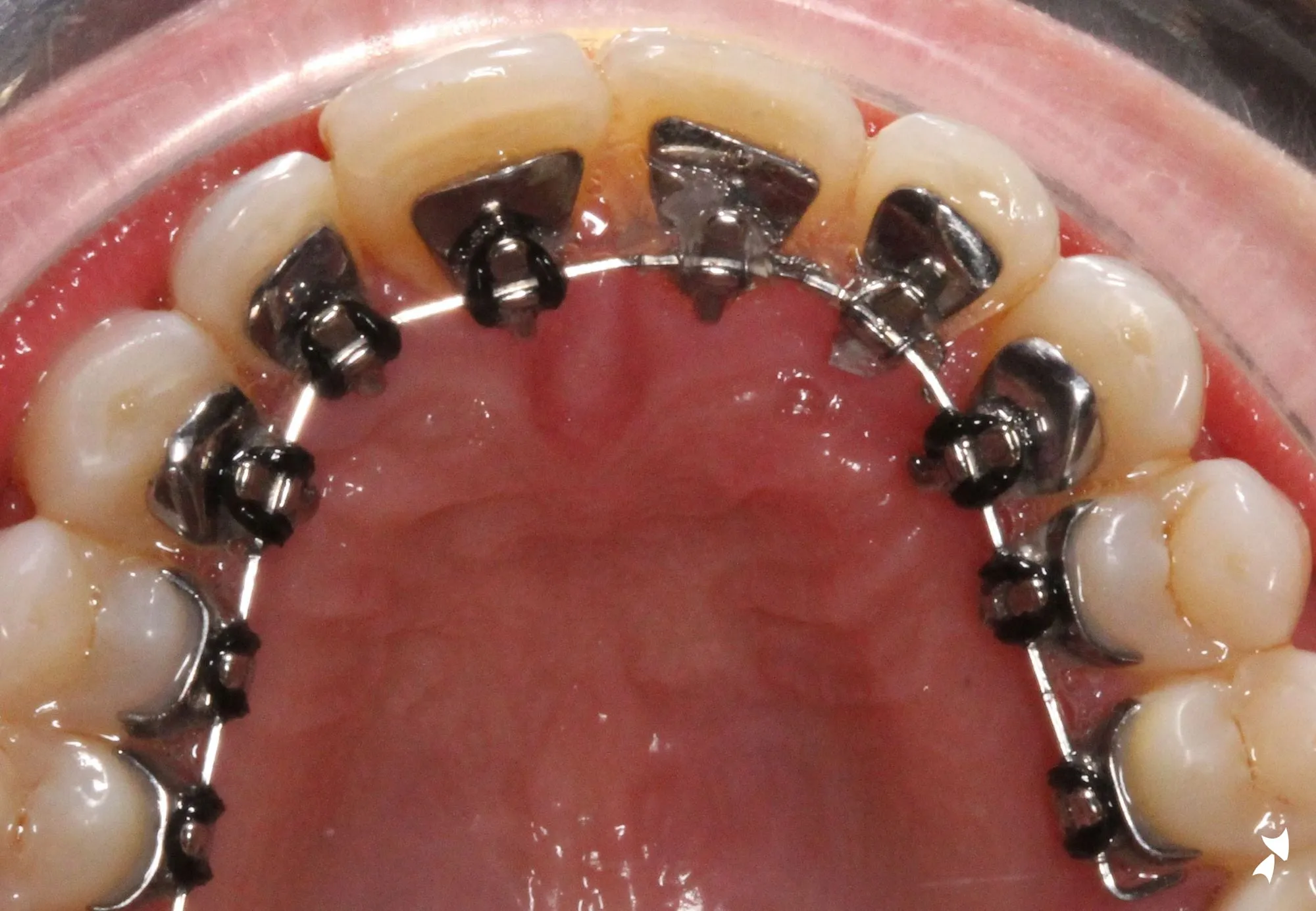 Lingual braces on the inside of the lower front teeth and premolars, photographed in clinic