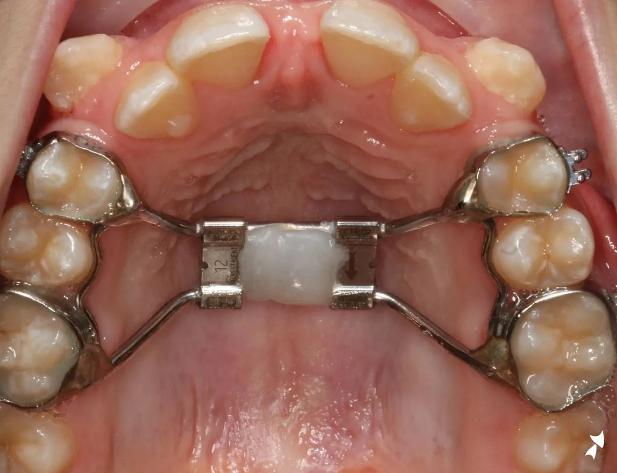 An upper jaw expander fitted to the back teeth, viewed from below, photographed in clinic